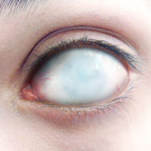 eyeball