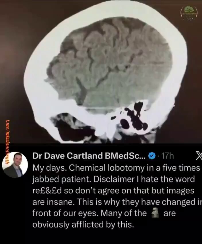 LOBOTOMY